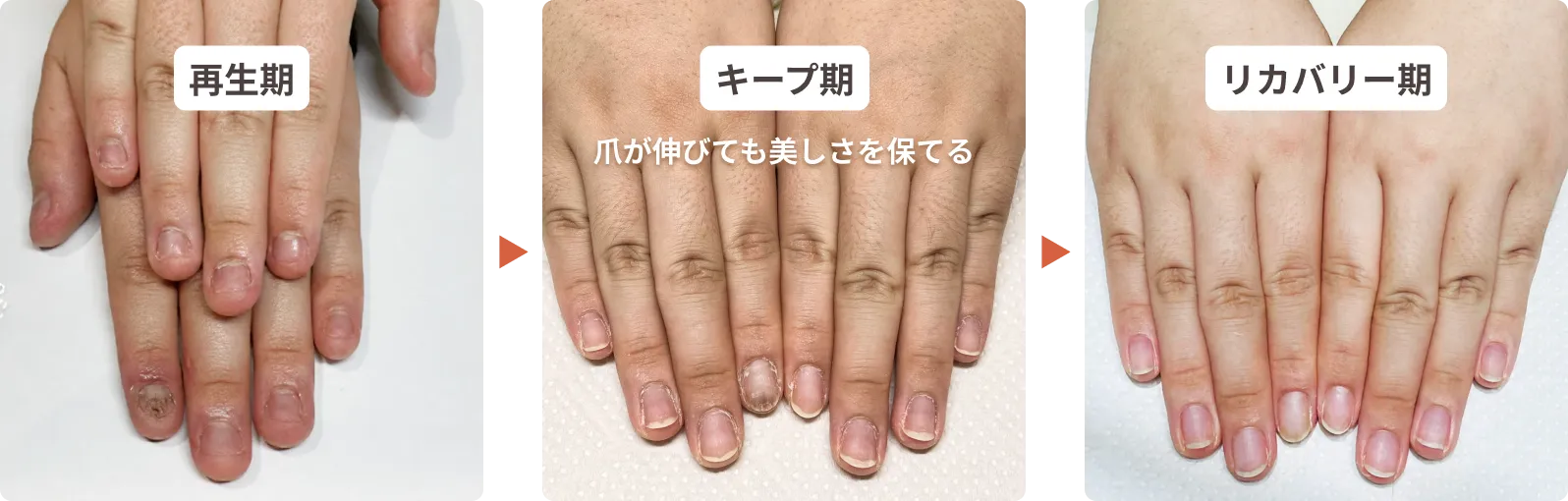 リプロネイル®式深爪矯正 アドバンス認定講座