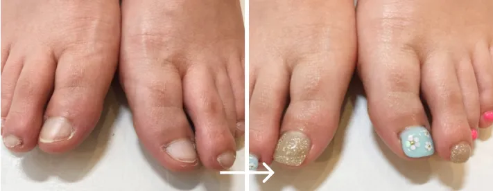 リプロネイル®深爪矯正　結果事例　フットネイル