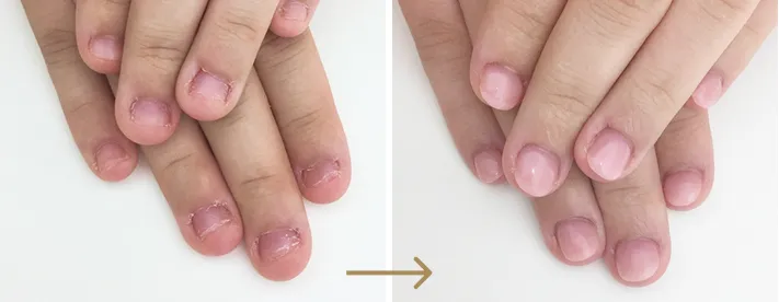 リプロネイル®深爪矯正　結果事例　ハンドネイル