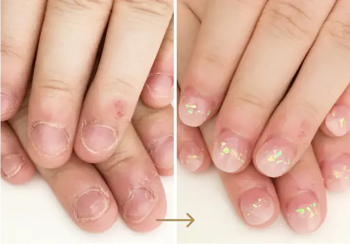 リプロネイル®式深爪矯正　結果写真