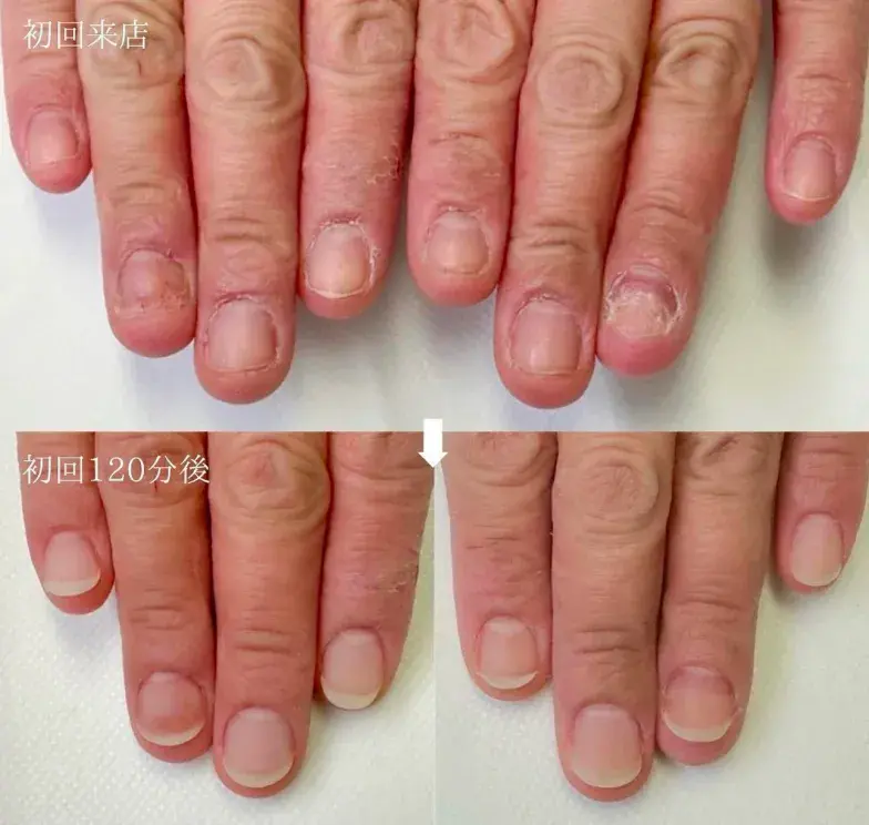 リプロネイル®深爪矯正　結果事例
