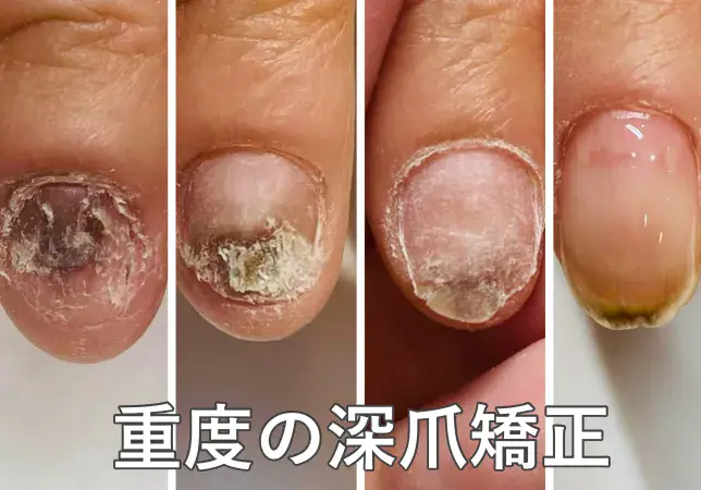 リプロネイル®深爪矯正　結果事例