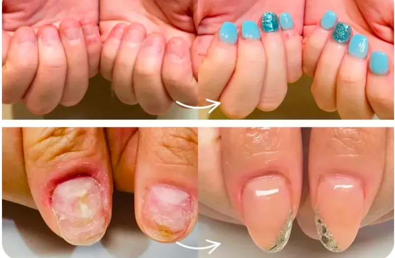 たった1回で劇的変化！深爪矯正革命