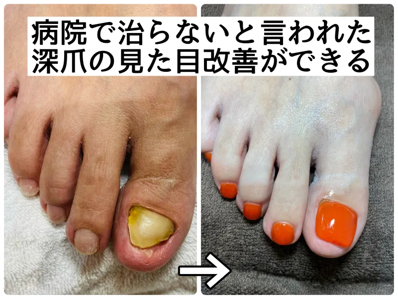 病院で治らないと言われた深爪の見た目改善ができる