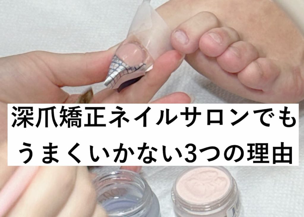 深爪矯正ネイルサロンでもうまくいかない3つの理由