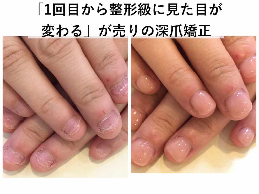 「1回目から整形級に見た目が変わる」が売りの深爪矯正