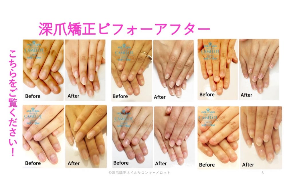 深爪矯正ビフォーアフター
