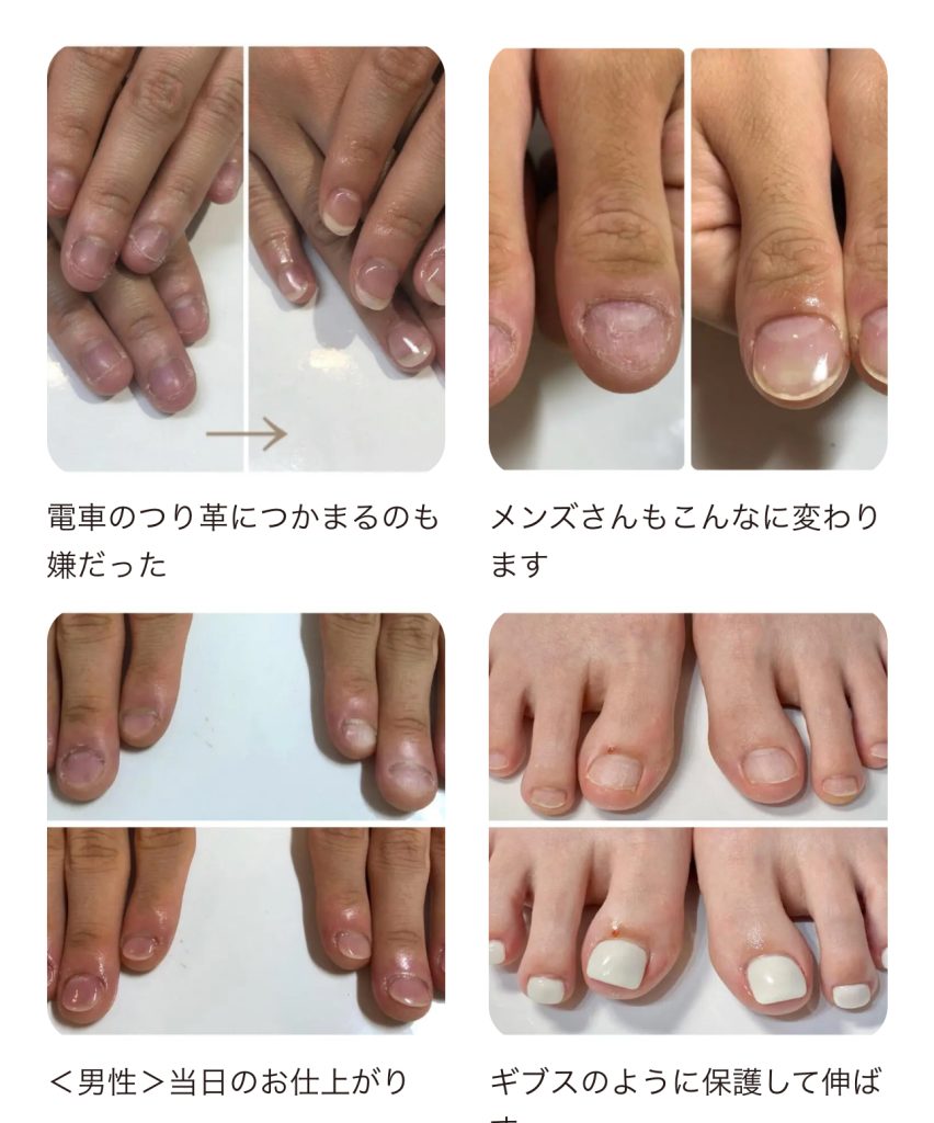 リプロネイル深爪矯正事例