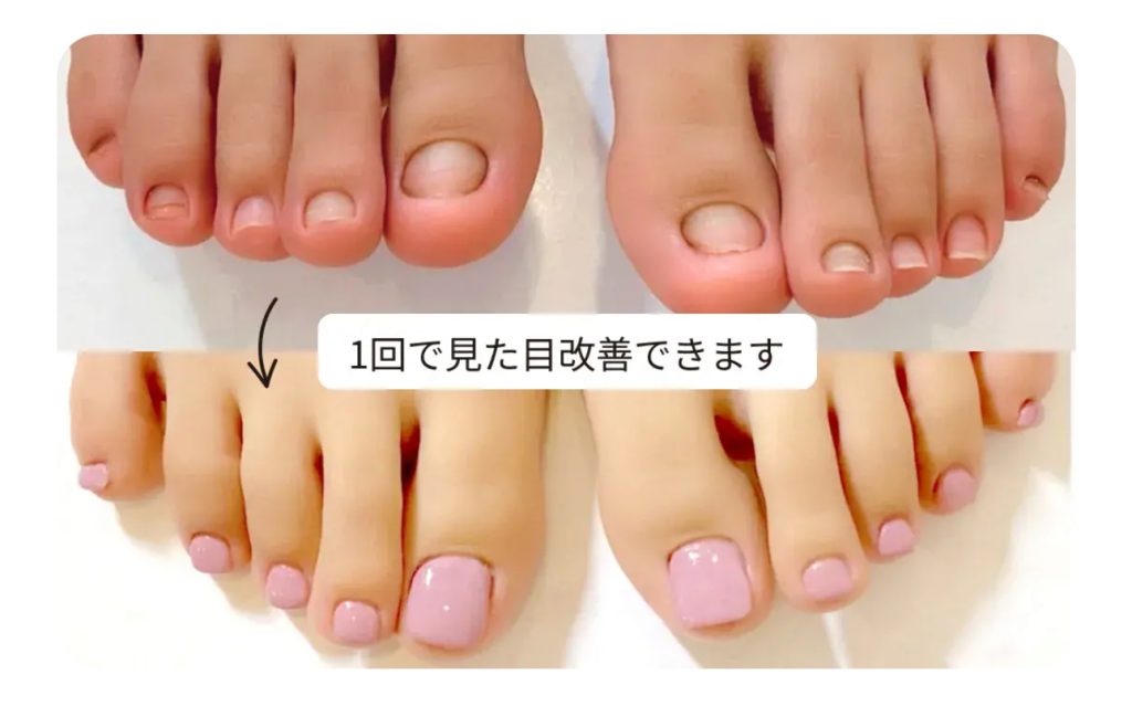 リプロネイル深爪矯正事例