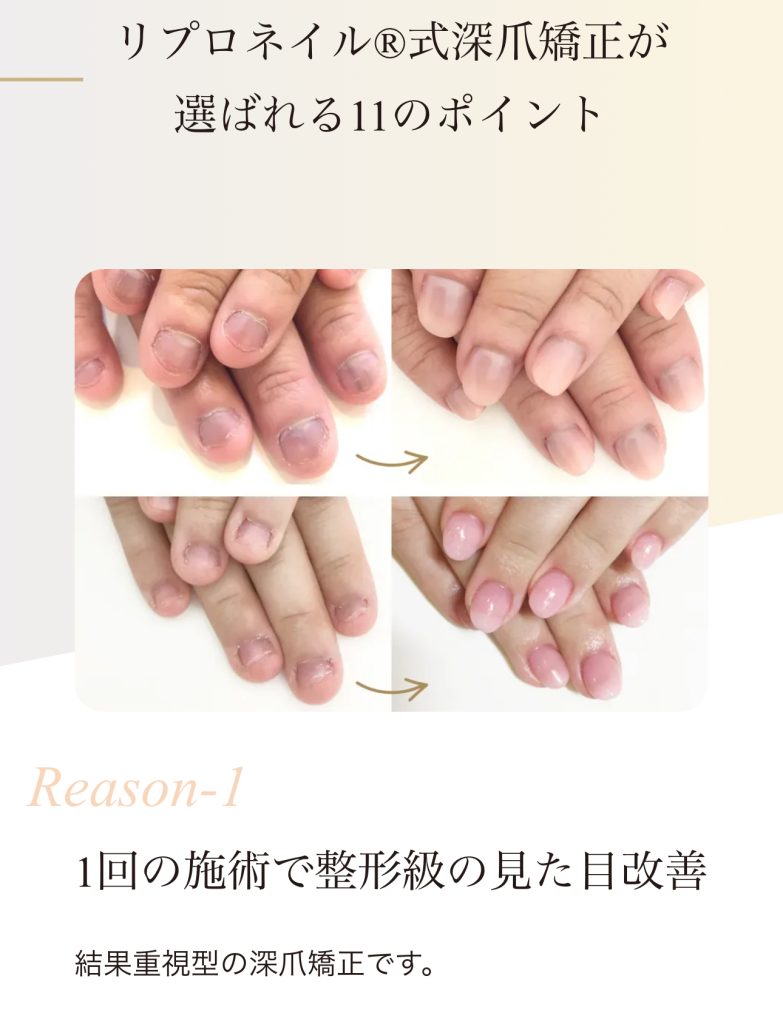 他の深爪矯正サロンとの違い