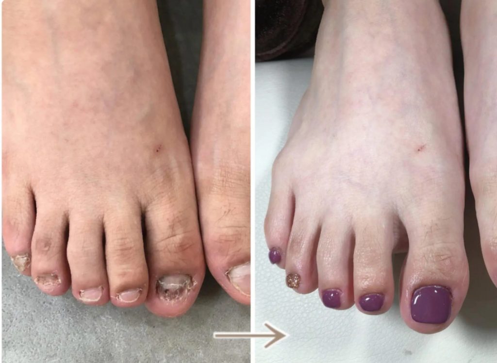 売り込まなくてもコースが売れやすい深爪矯正