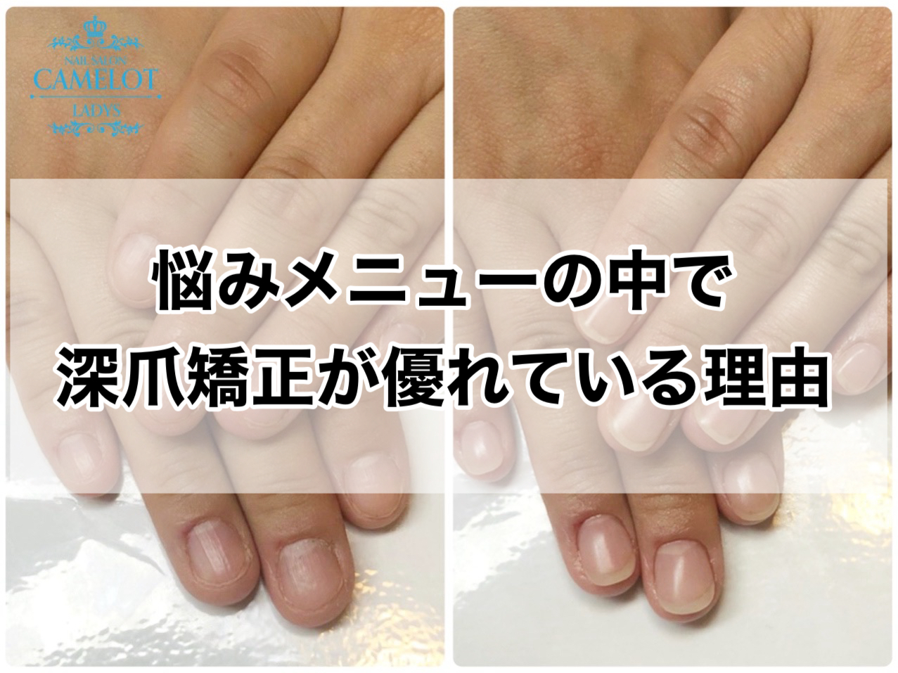 悩みメニューの中で深爪矯正が優れている理由