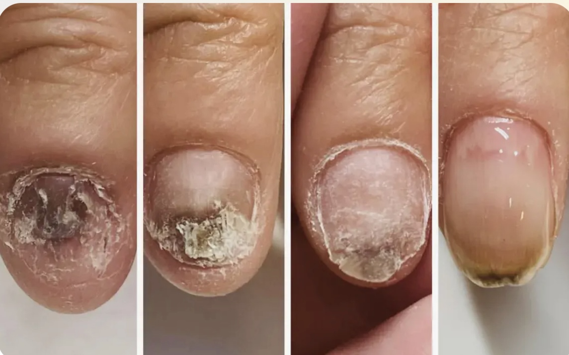 リプロネイル深爪矯正ビフォーアフター