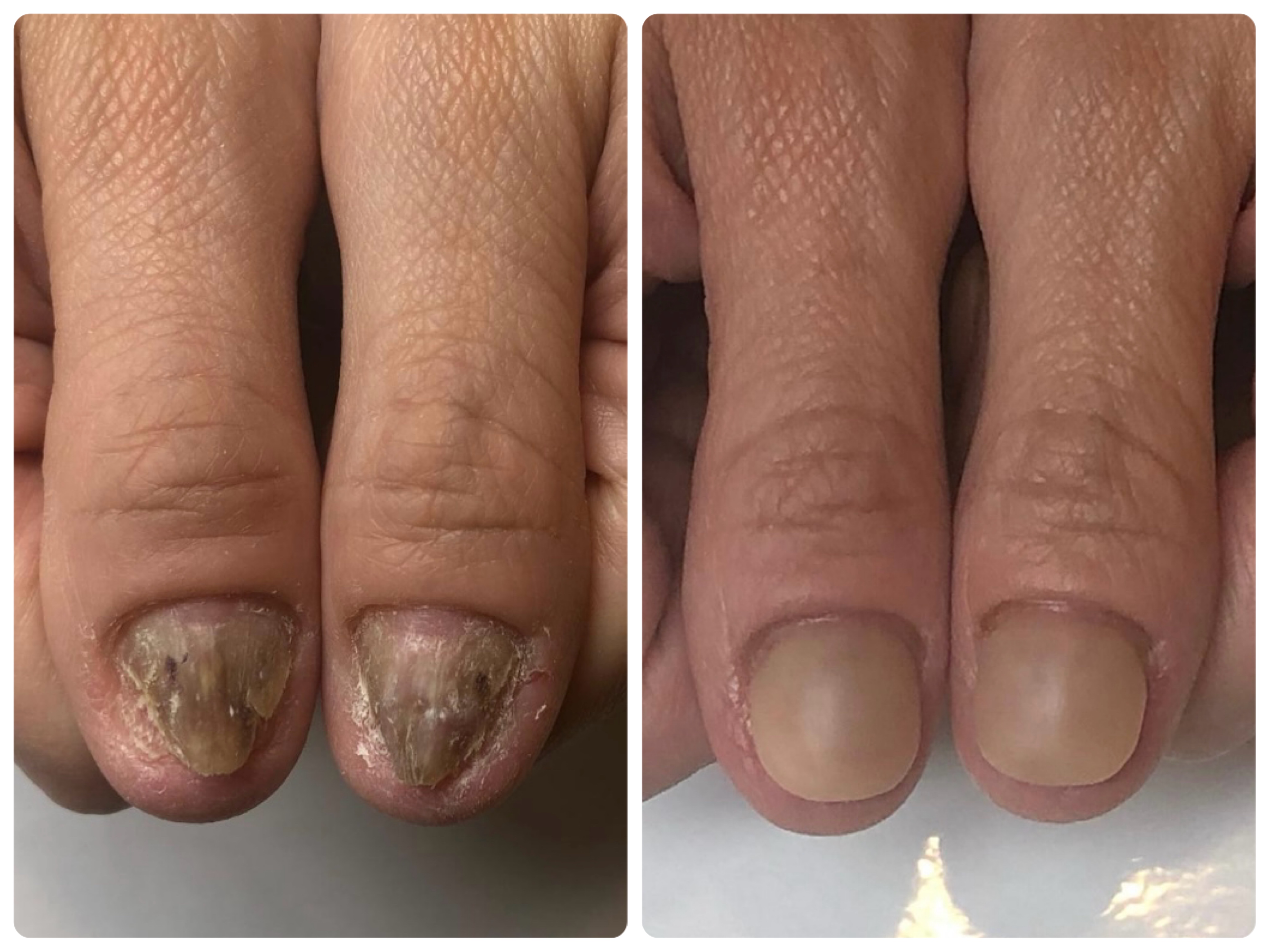 リプロネイル深爪矯正ビフォーアフター