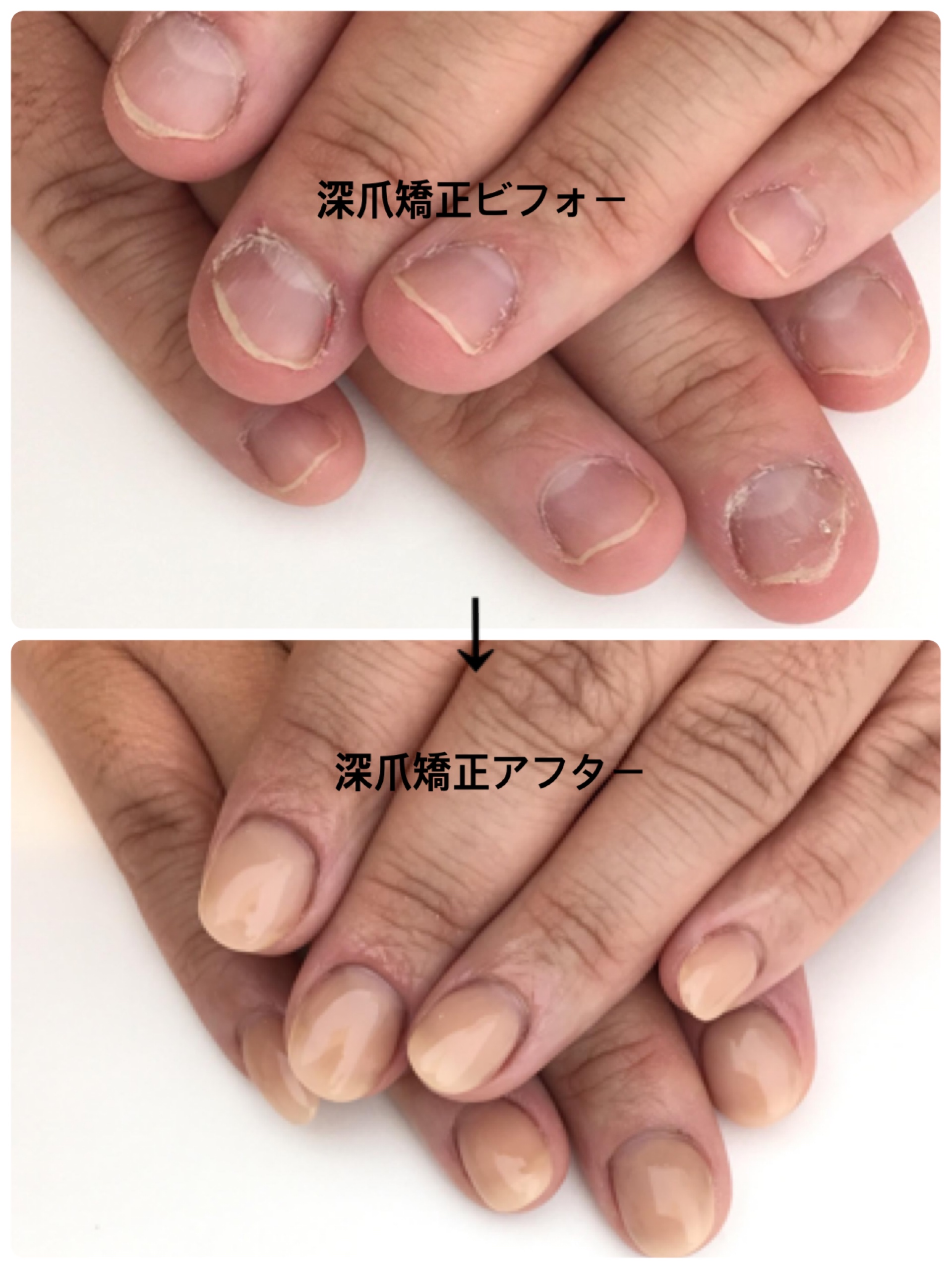 リプロネイル深爪矯正ビフォーアフター