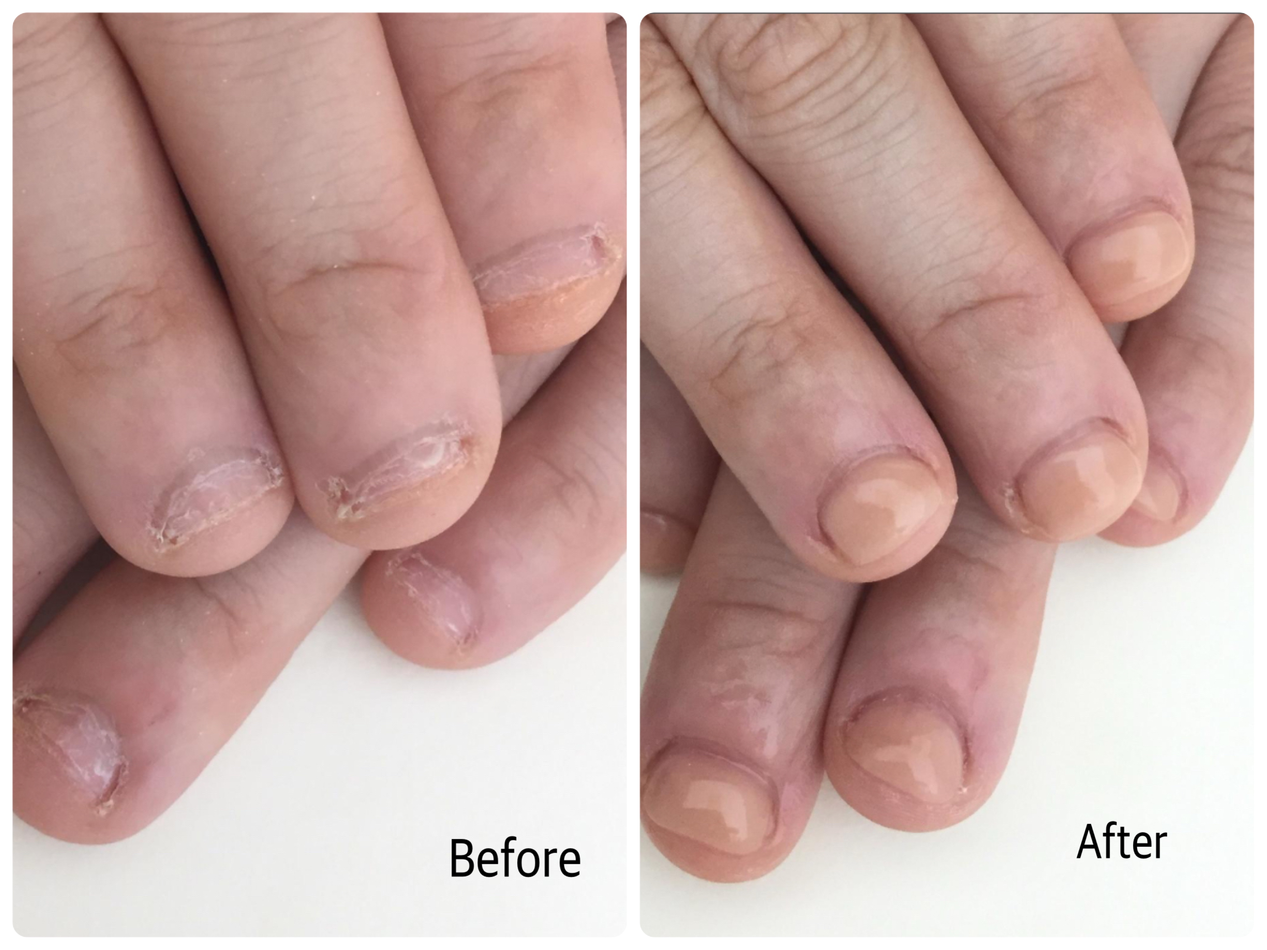 リプロネイル深爪矯正ビフォーアフター