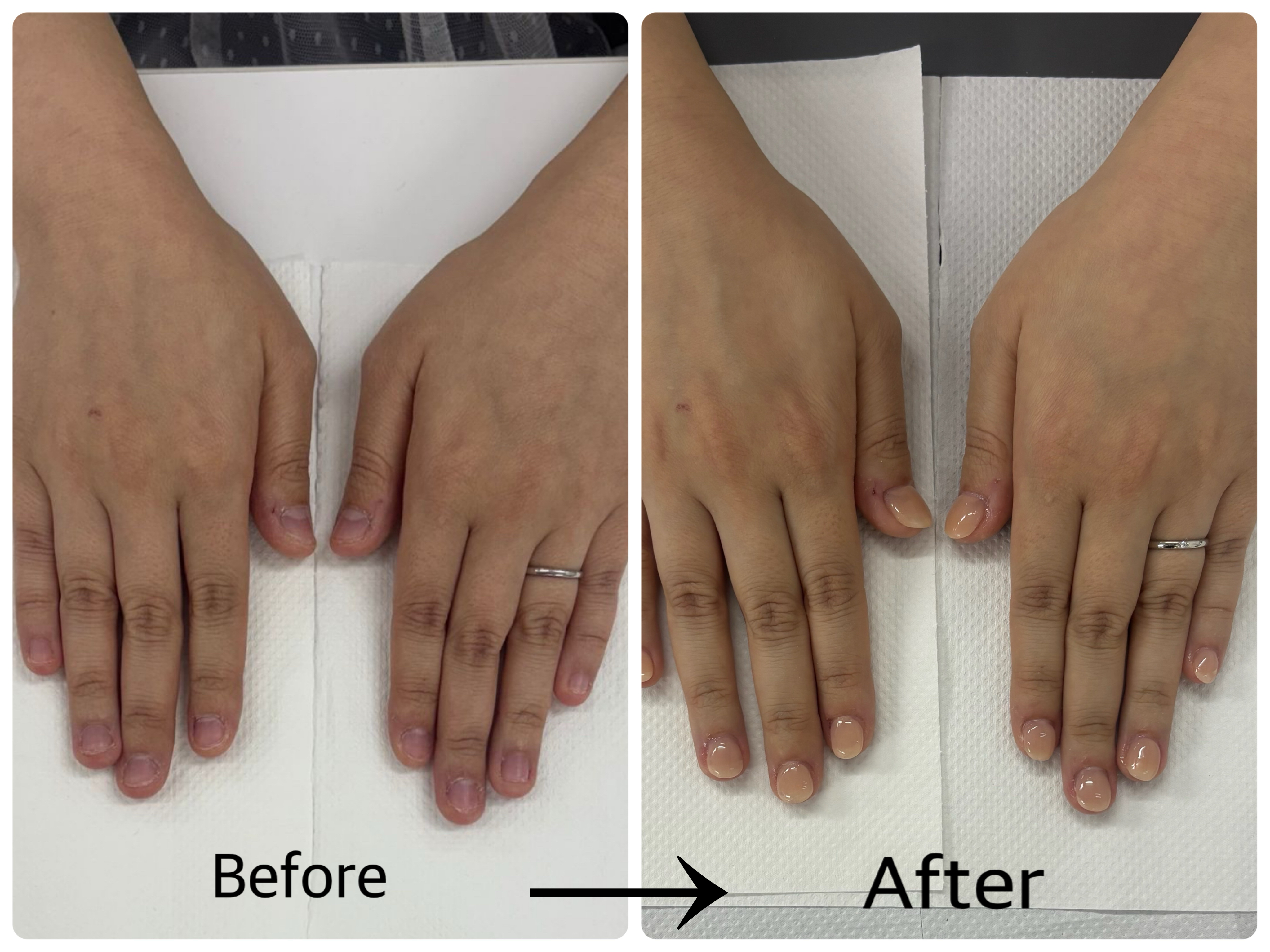 リプロネイル深爪矯正技術講習生の深爪施術結果写真