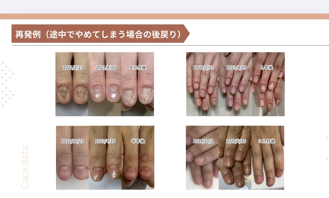 再発例（途中でやめてしまう場合の後戻り）