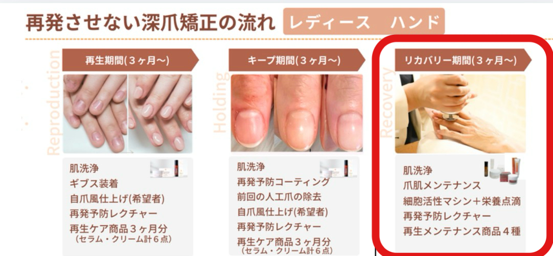 再発させない深爪矯正の流れ（レディースハンド）