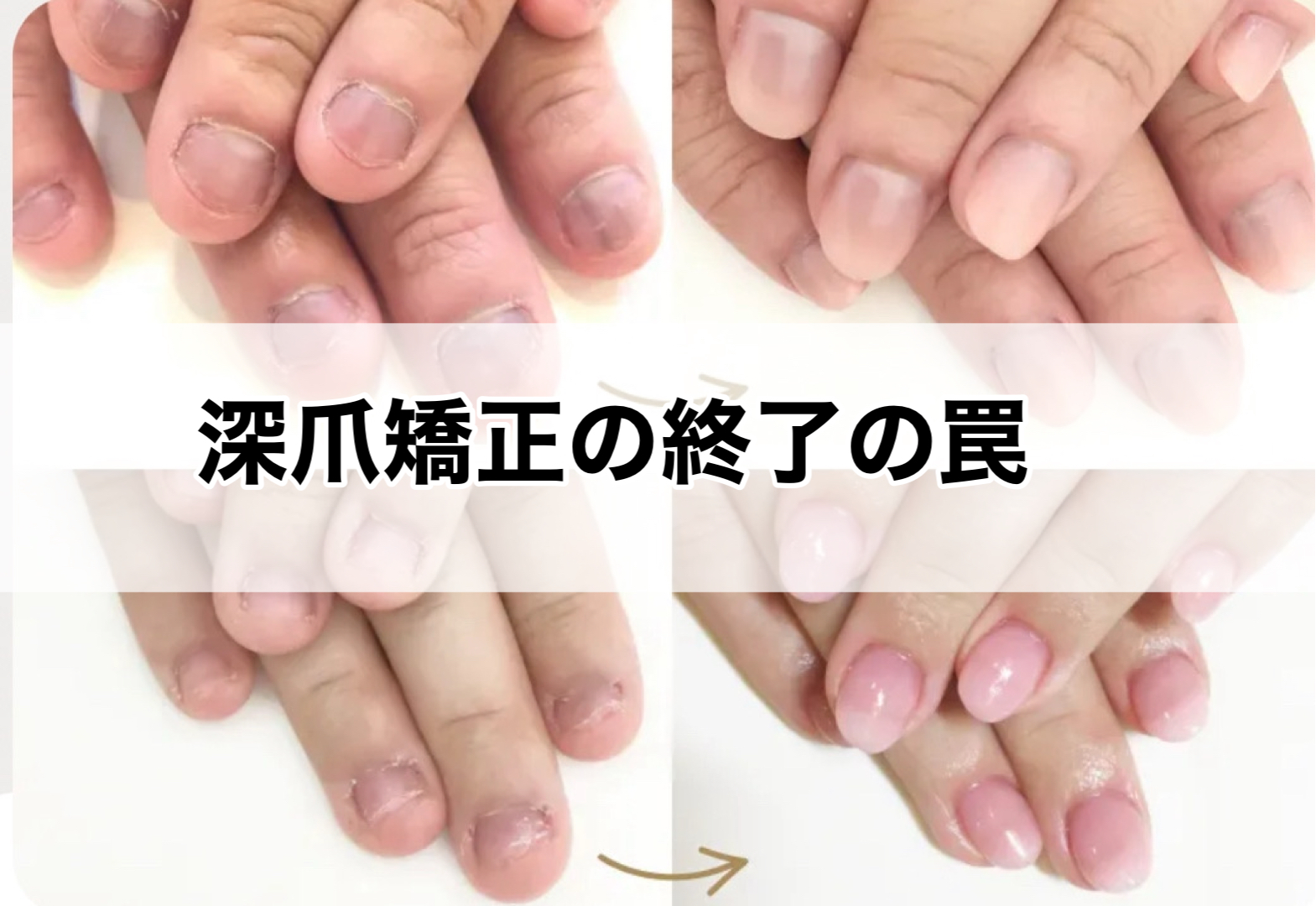 深爪矯正の“終了の罠”